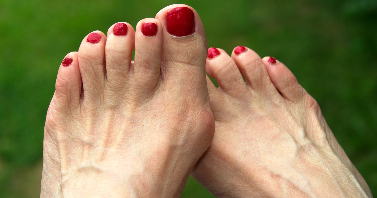 bunions