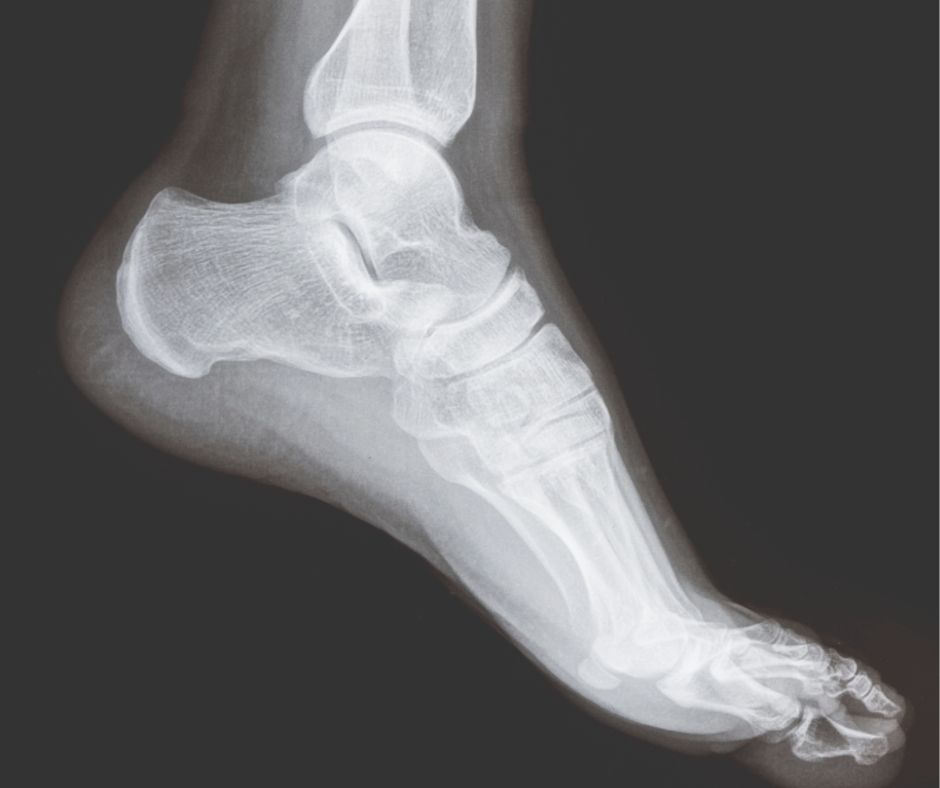 When to Refer for Imaging: X-ray in Foot and Ankle Pain